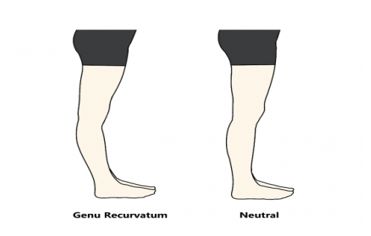 tratamentul vascular al genunchiului